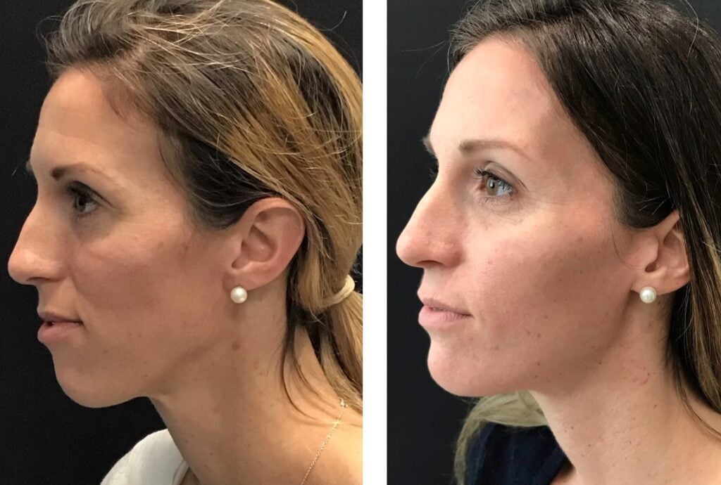 Photo of Jaw Surgery
