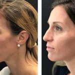 Photo of Jaw Surgery