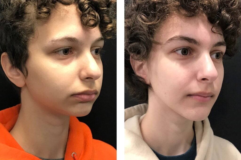 Photo of Jaw Surgery