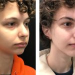 Photo of Jaw Surgery
