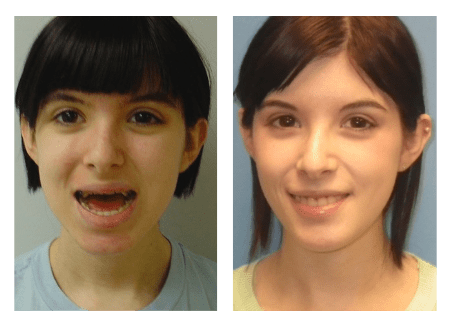 Photo of Jaw Surgery