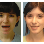 Photo of Jaw Surgery
