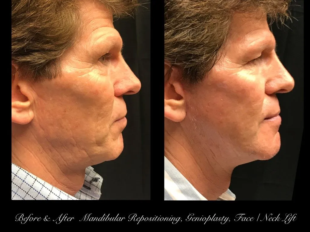 Photo of Jaw Surgery