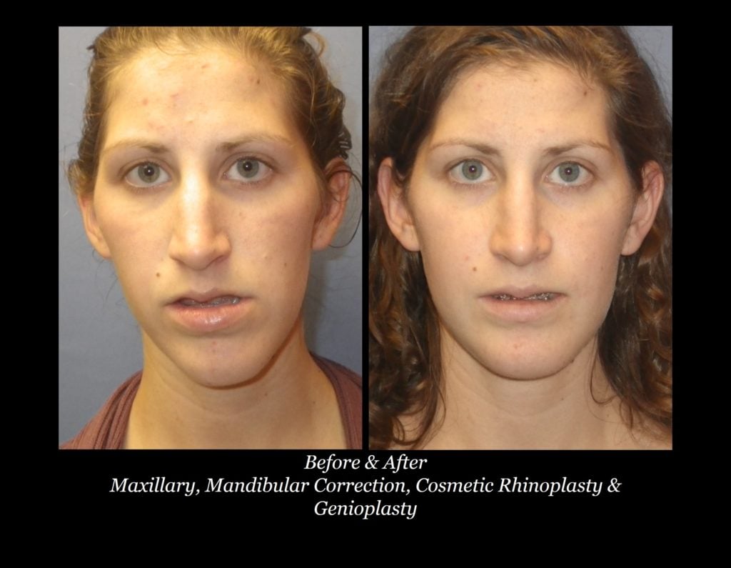 Photo of Jaw Surgery