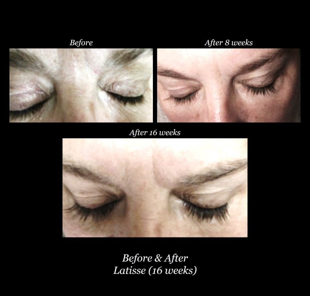 Photo of Latisse