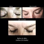 Photo of Latisse