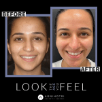 Photo of Microneedling