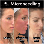 Photo of Microneedling
