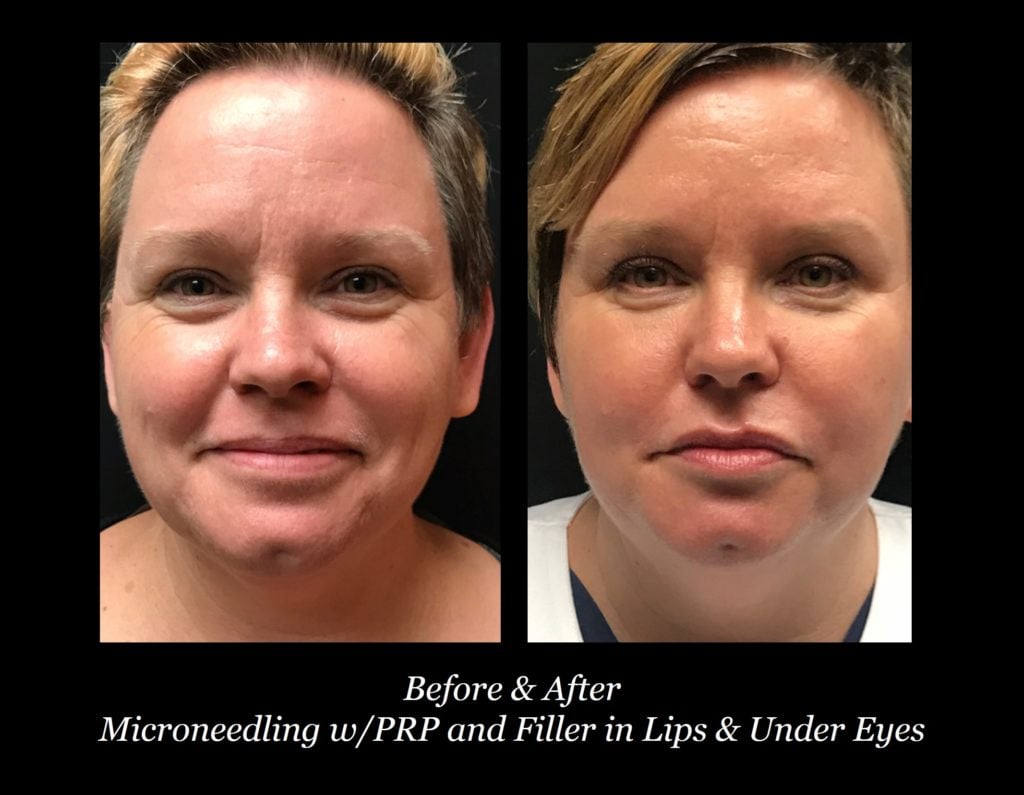 Photo of Microneedling