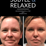 Photo of Microneedling