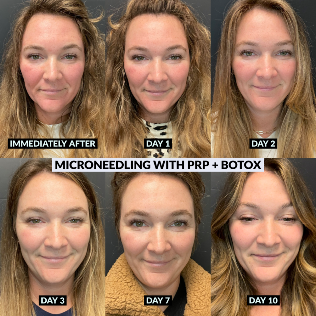Photo of Microneedling