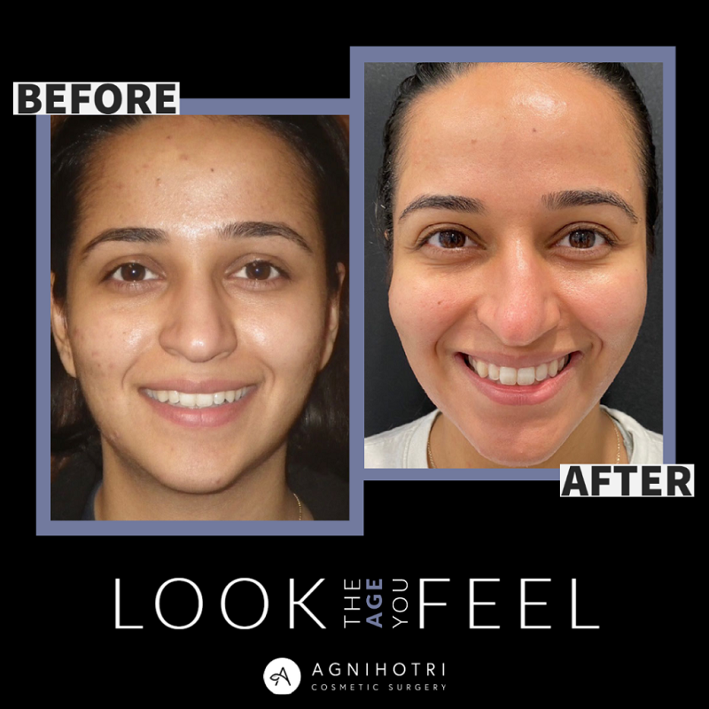 Collagen Induction before and after