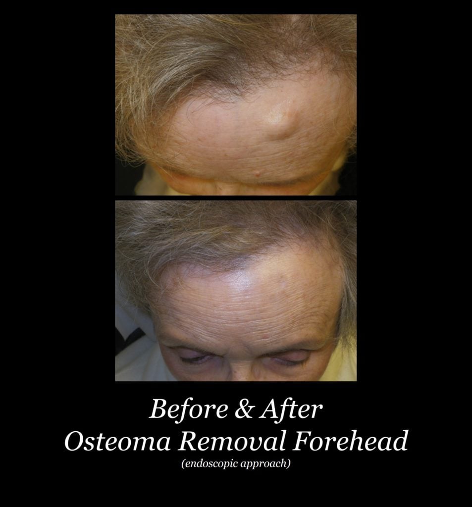 Photo of Osteoma