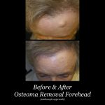 Photo of Osteoma