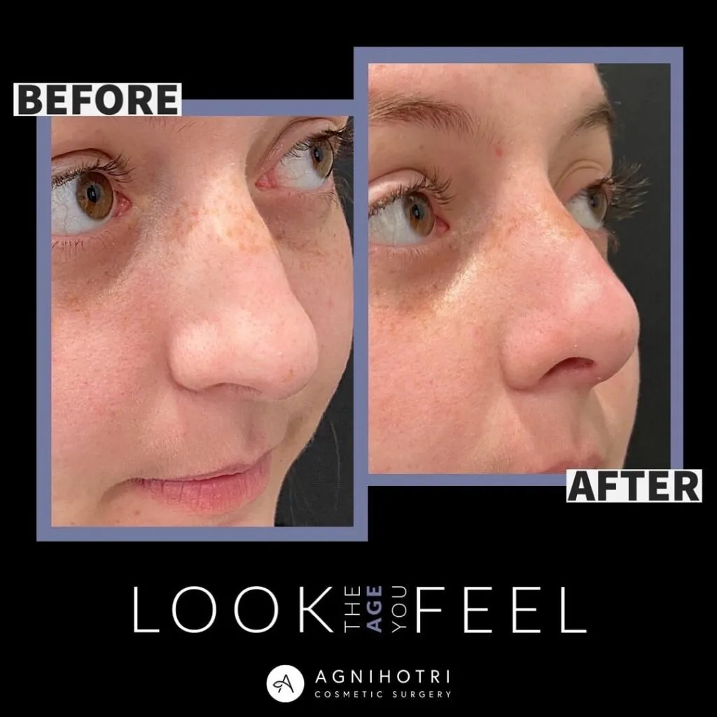 Photo of Rhinoplasty