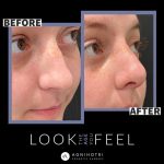 Photo of Rhinoplasty