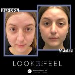 Photo of Rhinoplasty