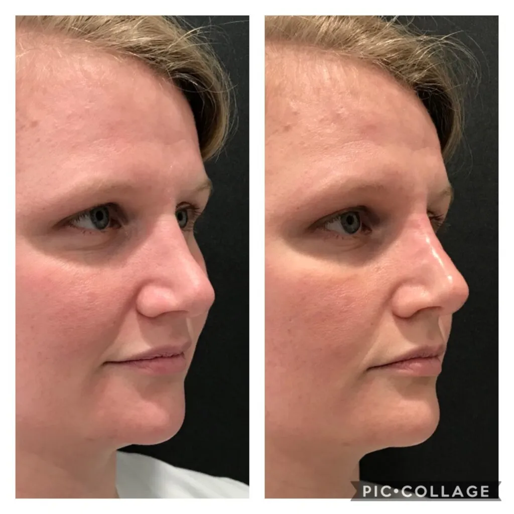 Photo of Rhinoplasty