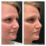 Photo of Rhinoplasty
