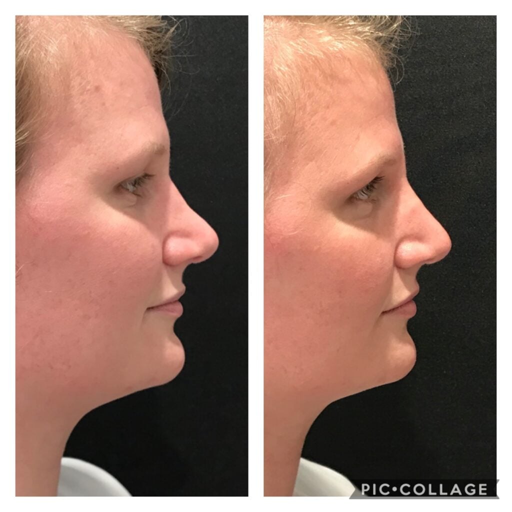 Photo of Rhinoplasty