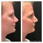 Photo of Rhinoplasty