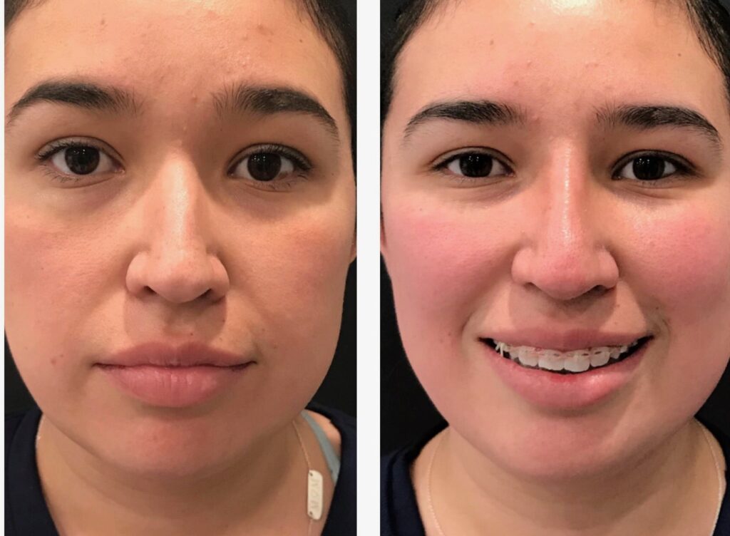 Photo of Rhinoplasty