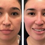 Photo of Rhinoplasty