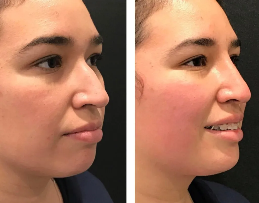Photo of Rhinoplasty