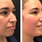 Photo of Rhinoplasty