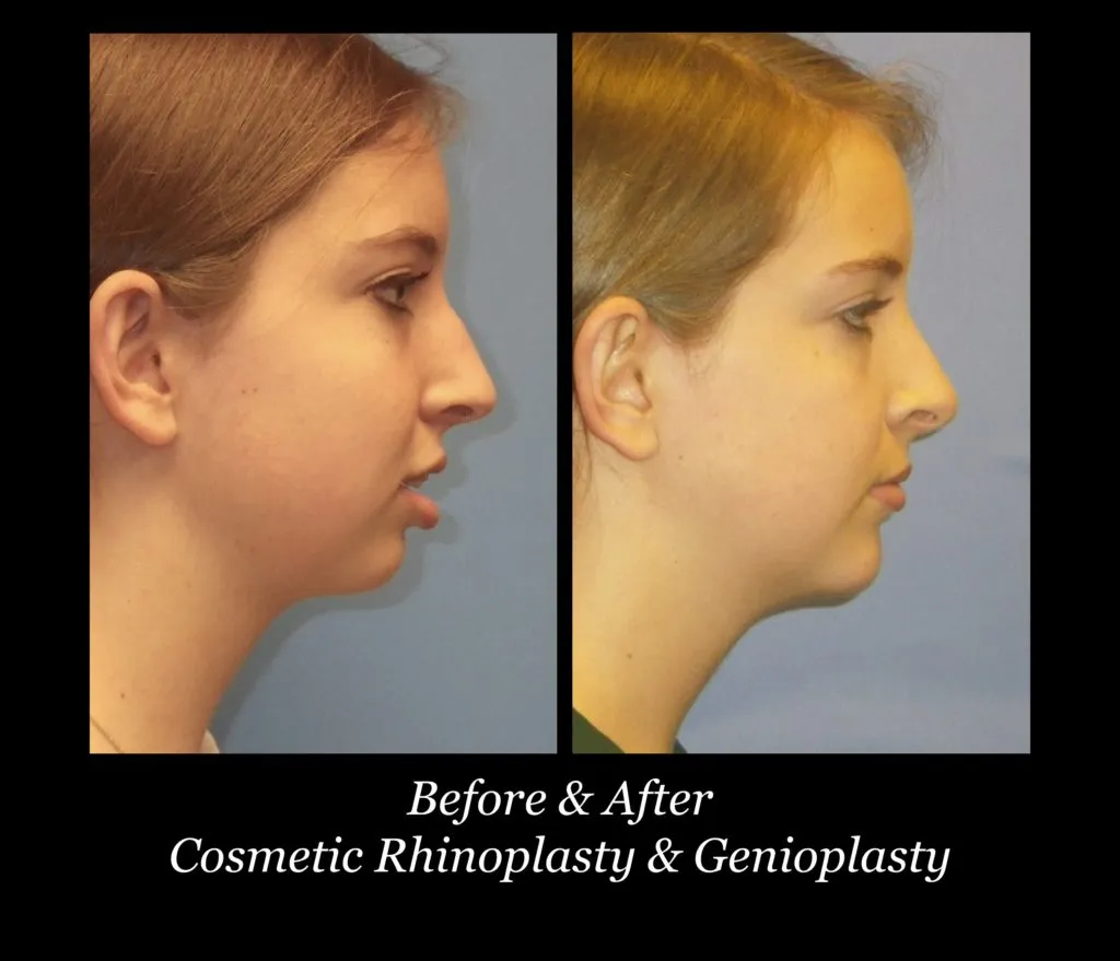 Photo of Rhinoplasty