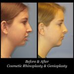 Photo of Rhinoplasty