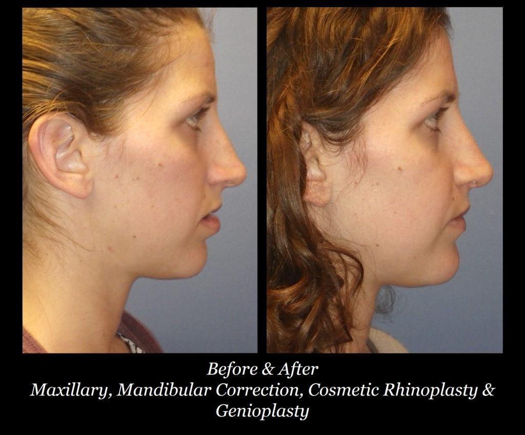 Photo of Rhinoplasty
