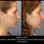 Photo of Rhinoplasty