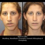 Photo of Rhinoplasty