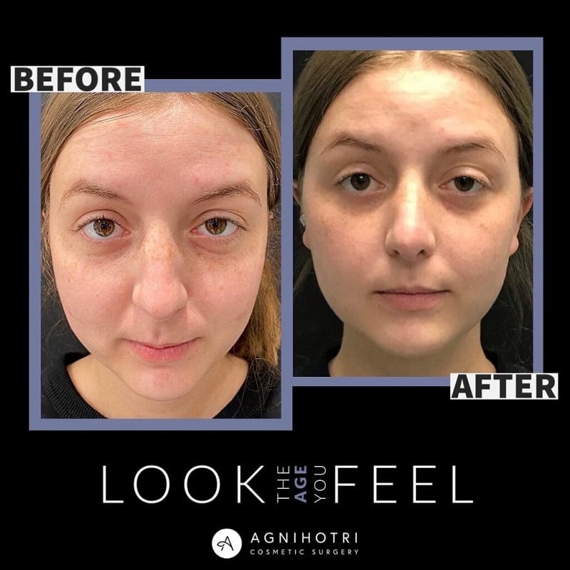 Rhinoplasty before and after