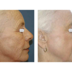 Photo of Skin Resurfacing