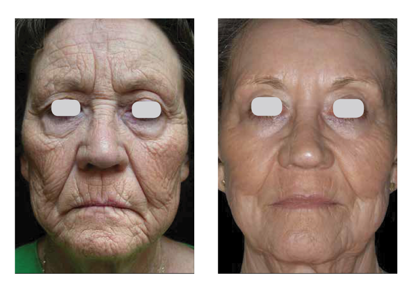 Photo of Skin Resurfacing
