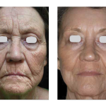 Photo of Skin Resurfacing