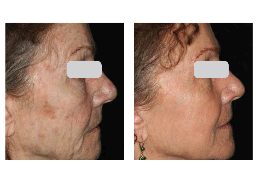 Photo of Skin Resurfacing