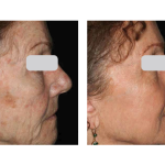 Photo of Skin Resurfacing
