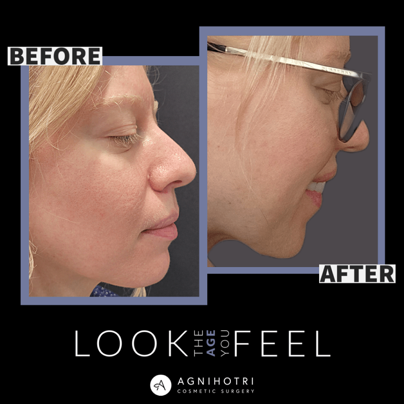 Hydrafacial before and after