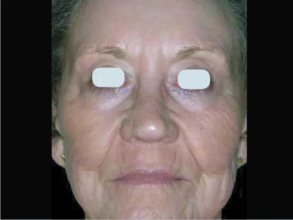 Skin Resurfacing After