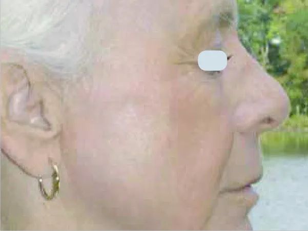 Skin Resurfacing After