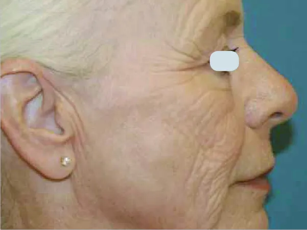 Skin Resurfacing Before