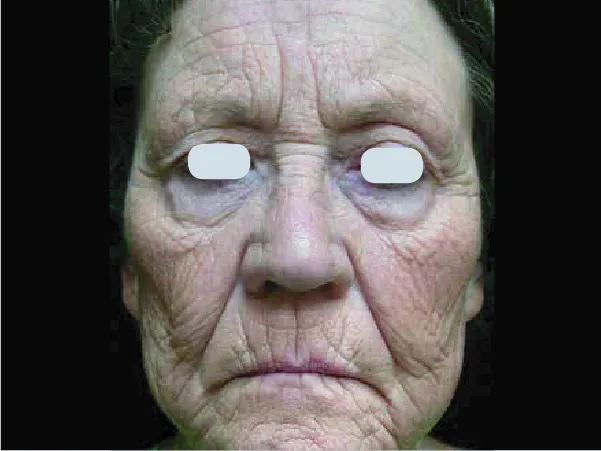Skin Resurfacing Before