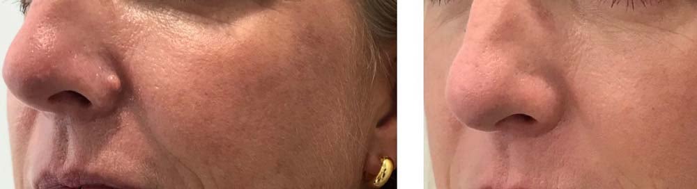 Photo of Scarless Mole and Skintag Removal