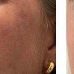 Photo of Scarless Mole and Skintag Removal