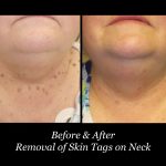 Photo of Scarless Mole and Skintag Removal