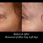 Photo of Scarless Mole and Skintag Removal