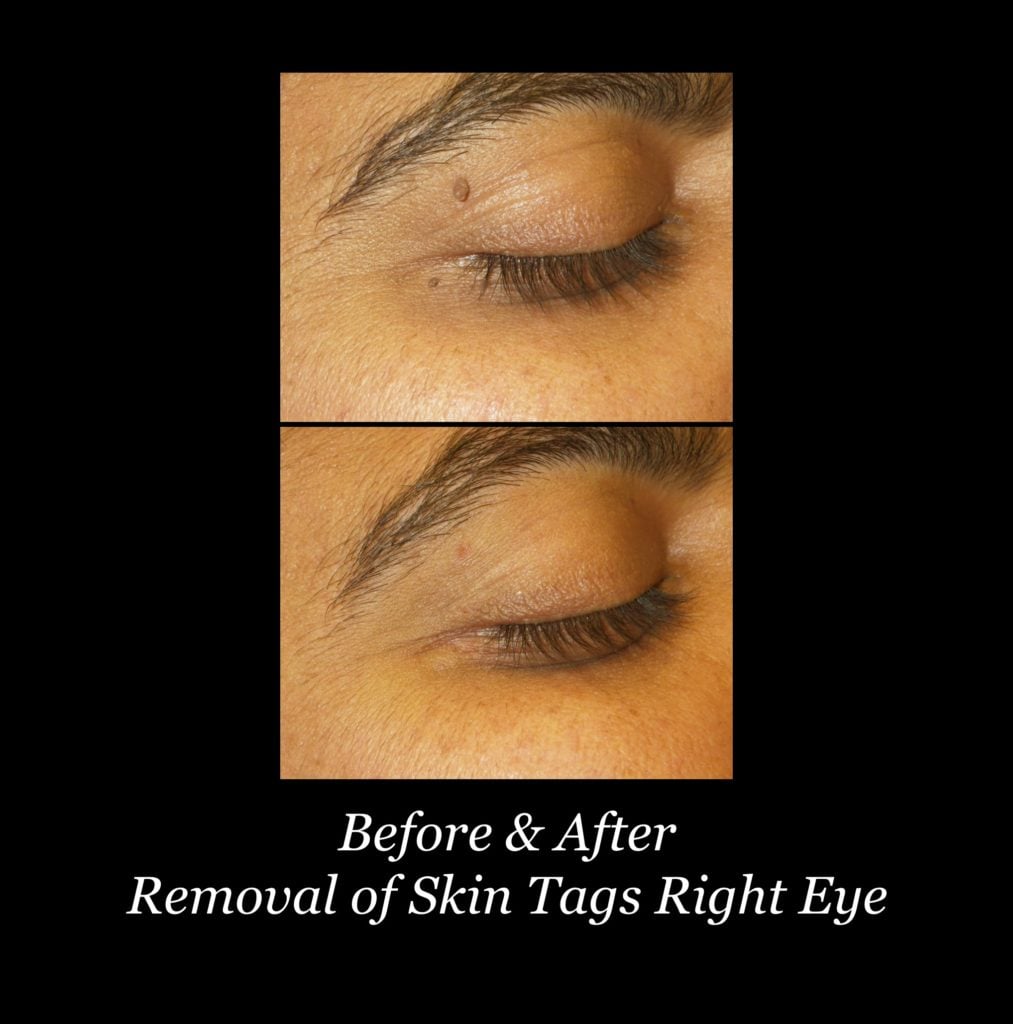 Photo of Scarless Mole and Skintag Removal